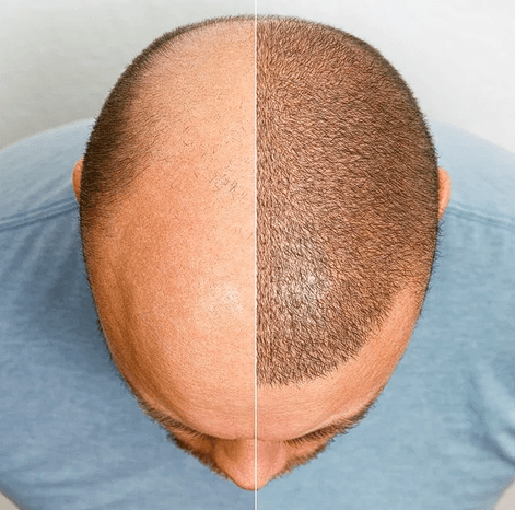 Best Hair Transplant in Saudi Arabia