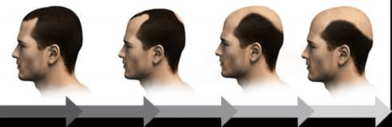 Best Hair Transplant in Saudi Arabia