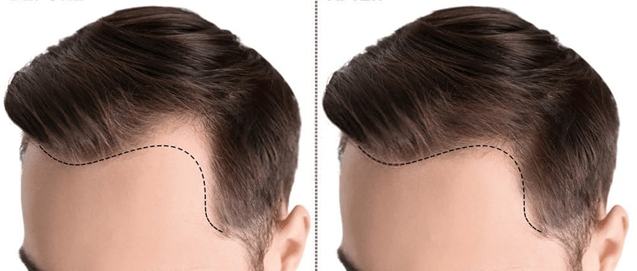 Best Hair Transplant in Saudi Arabia