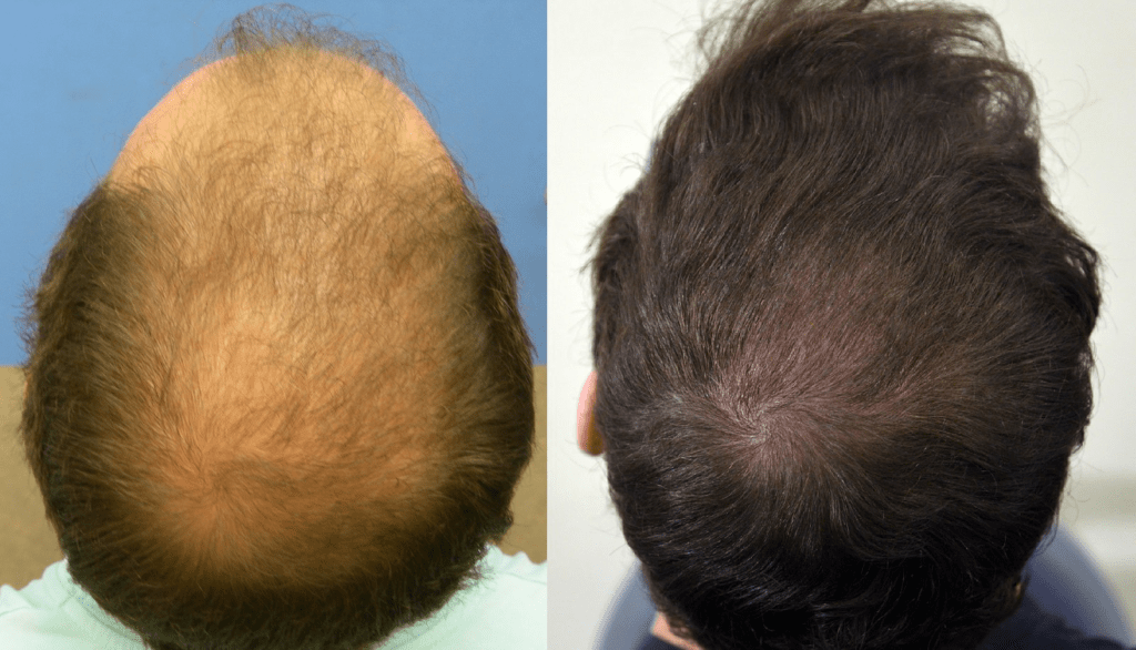 Best Hair Transplant in Saudi Arabia