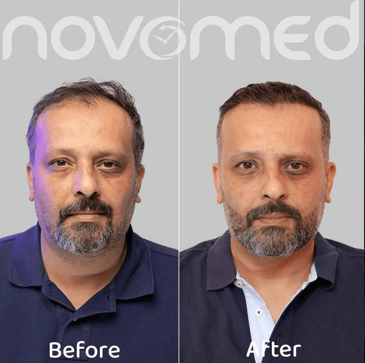 Best Hair Transplant in Saudi Arabia