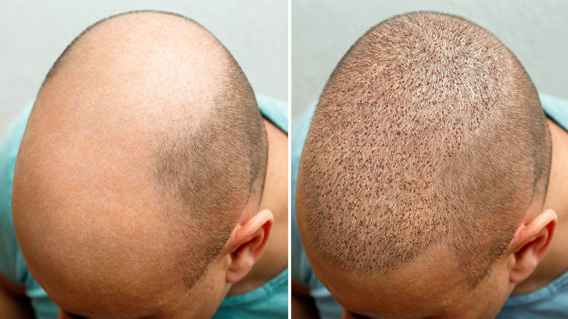 Hair Transplant in Riyadh